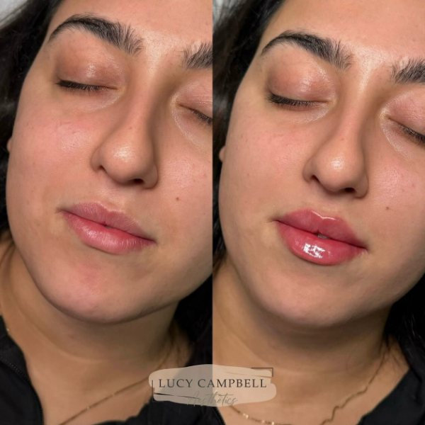 Dermal Filler results