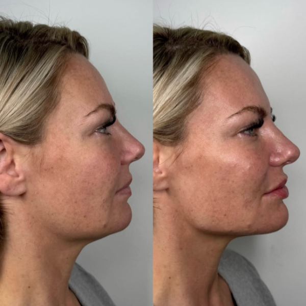 Profile Balancing