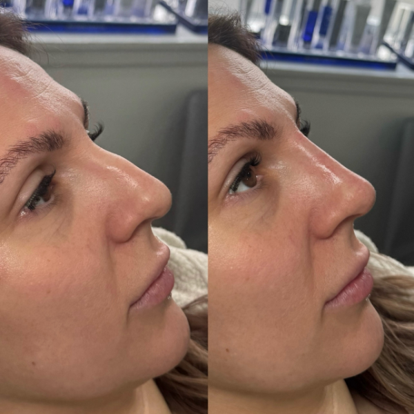 Non Surgical Rhinoplasty